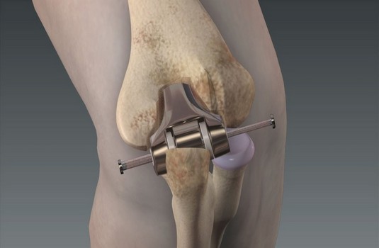Elbow Replacement 2